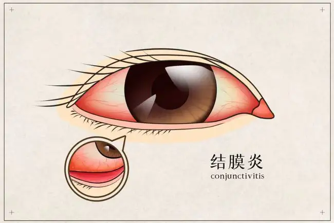 皮膚癢、拉肚子、腸胃不適、感冒，春夏換季病，艾灸來(lái)搞定！